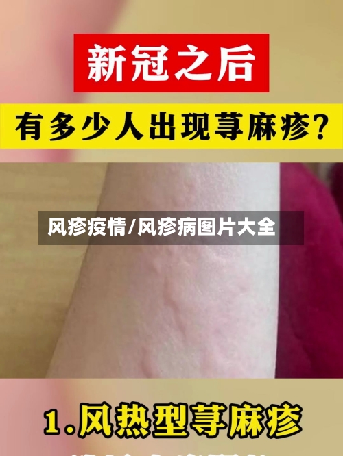 风疹疫情/风疹病图片大全-第2张图片
