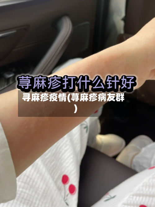 寻麻疹疫情(荨麻疹病友群)-第1张图片